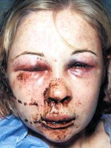 beaten