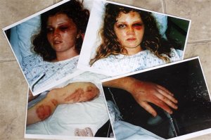 Police photos of Heather Thompson in a hospital bed are displayed at her home in Monroe, N.C. Thursday, May 28, 2009. Thompson was 23 in 1994 when her then-husband Thomas Howard Price Jr beat her senseless, leaving her with bone spurs, pinched nerves and osteoarthritis. She has taught law officers about domestic violence in the years since Price vowed in a letter from prison to kill her and their daughters. Price was released Friday May 29, 2009, from a federal prison in South Carolina. (AP Photo/Nell Redmond)