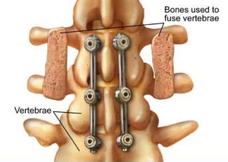 lumbar-spine-surgery
